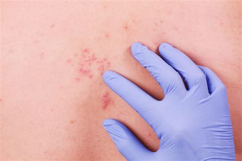 Herpes Zoster Causas S Ntomas Y Prevenci N