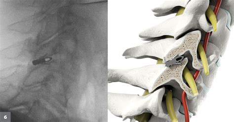 Minimally invasive posterior cervical fusion augments three-level ...