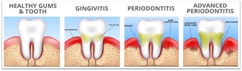 Types Of Dental Cleaning Mohip Dental Associates