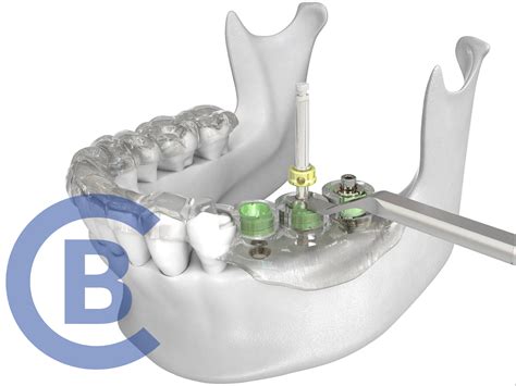 Cirugía guiada de implantes Qué ventajas tiene Clínica Blasi