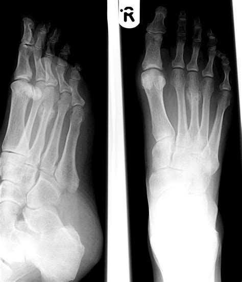 3Rd Metatarsal Fracture Healing Time / Toe And Forefoot Fractures ...