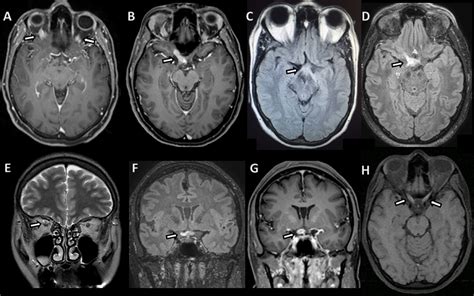 Acute Optic Nerve Lesions In First Ever Nmosd Related Optic Neuritis Using Conventional Brain