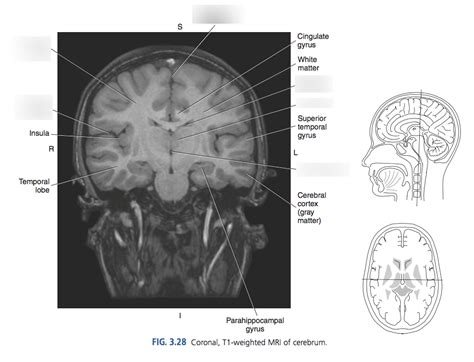 Coronal MRI of Cerebrum Diagram | Quizlet