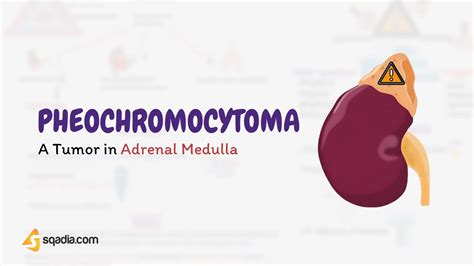 Pheochromocytoma