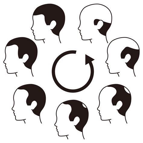 Understanding Hair Loss | Crown Hair Institute