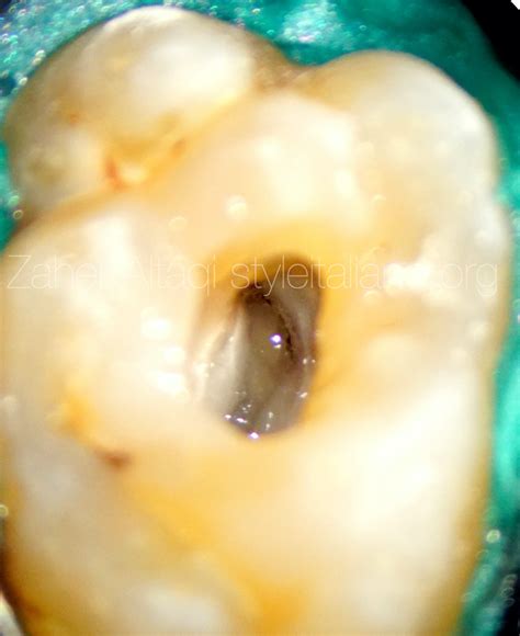 Unusual anatomy in upper second molar - Style Italiano Endodontics