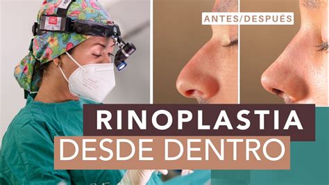 Rinoplastia Ultrasónica explicada Procedimiento y ventajas YouTube