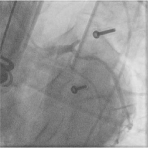 Post Arrest Angiogram Showing Acutely Totally Occluded Proximal Left Download Scientific