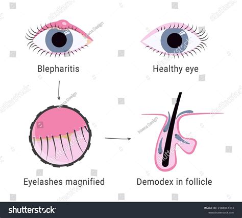 Demodex Infection Causing Blepharitis Eyelash Mites Stock Vector Royalty Free 2184047333