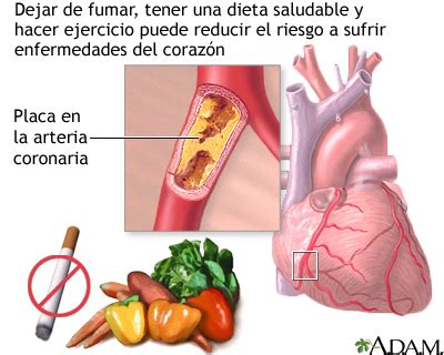 Prevención de la enfermedad cardíaca MedlinePlus enciclopedia médica