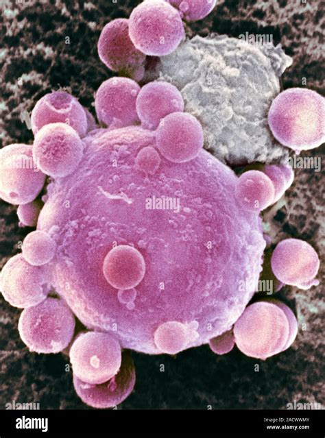 Lymphocyte Attacking Cancer Cell Coloured Scanning Electron Micrograph