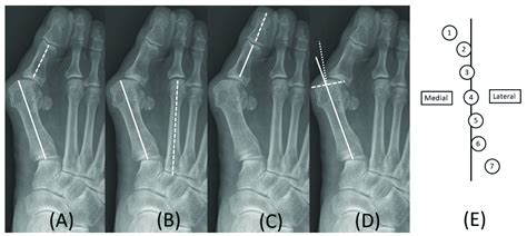 Contribution Ratio Of Metatarsal Osteotomy And First Tarsometatarsal