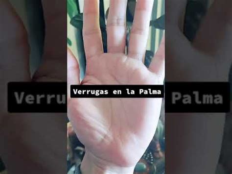 Verrugas En La Palma De La Mano YouTube