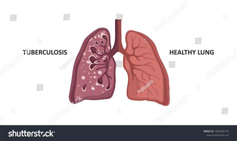 Healthy Lung Lung Infected Tuberculosis Stock Vector Royalty Free