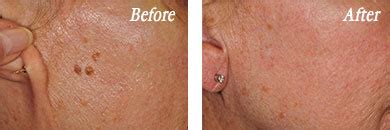 Seborrheic Keratosis Removal New Orleans - Skin Growth Treatments