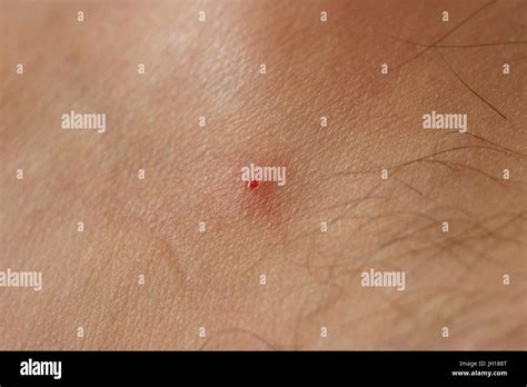 Black fly bite, skin, people, São Paulo, Brazil Stock Photo - Alamy