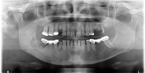 Osteonecrosis Of The Jaw Bone