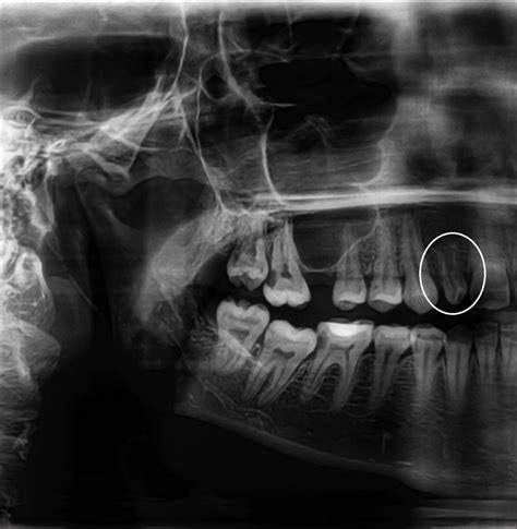 Panoramic radiograph shows Type III dens invaginatus in the maxillary ...