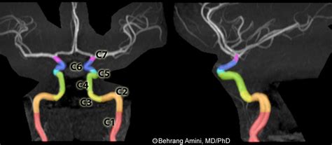 Roentgen Ray Reader Segments Of The Internal Carotid Artery