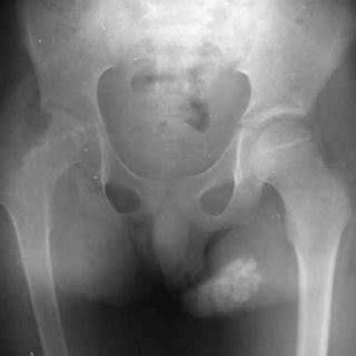 Case 2 Anteroposterior Radiograph Of The Pelvis Showing Destruction Of