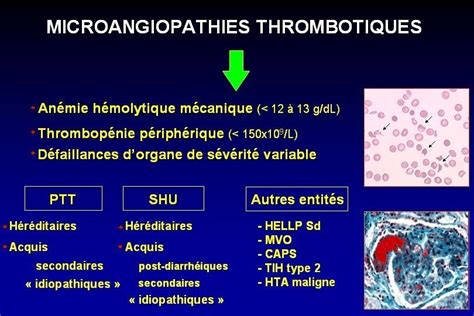 Microangiopathies Thrombotiques Physiopathologie Classification Paul