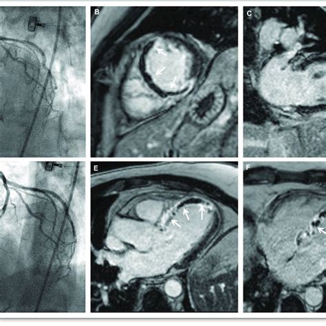 Transmurality Index And Myocardial Salvage Index Time Dependent