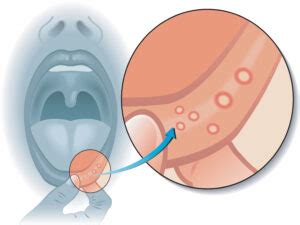 Should You Try To Pop A Canker Sore NewMouth