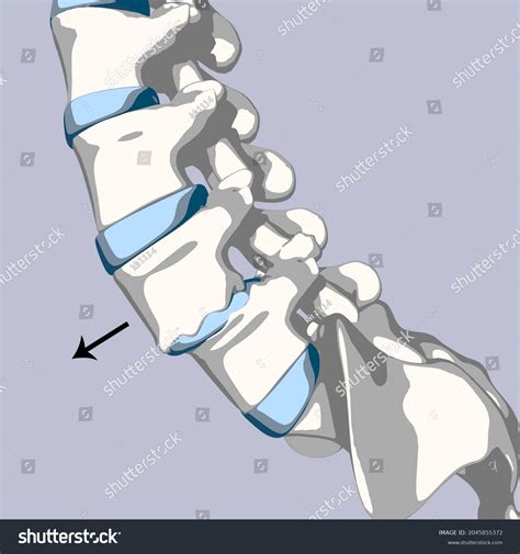 3d Illustration Spondylolisthesis Stages Main Description 库存插图