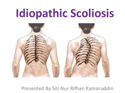 Idiopathic Scoliosis