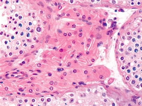 Leydig Cells Reinke Crystals In 40 Of Leydig Cell Tumours