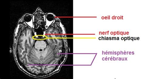 IRM chiasma optique légendé