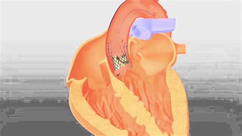 Corevalve Transcatheter Aortic Valve Replacement By Medtronic Youtube