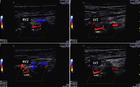 Duplex ultrasound examination. Hypoechoic "halo" sign in both vertebral ...