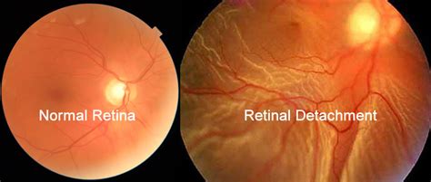 Retinal Detachment