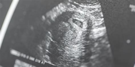 Anomaly Scan Why The 20 Week Ultrasound Is Important