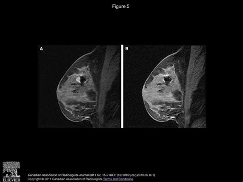 Magnetic Resonance Imaging Guided Breast Biopsies Tips And Tricks Ppt Download