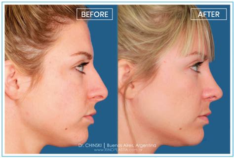 Hanging Columella Rhinoplasty Dr Chinski