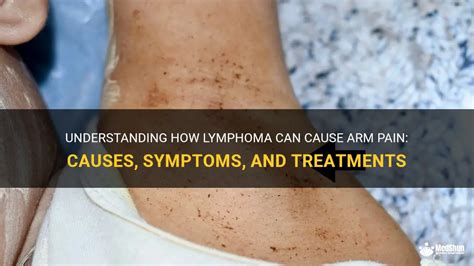 Understanding How Lymphoma Can Cause Arm Pain Causes Symptoms And