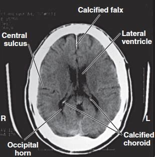 lateral ventricles - Critical Care Practitioner