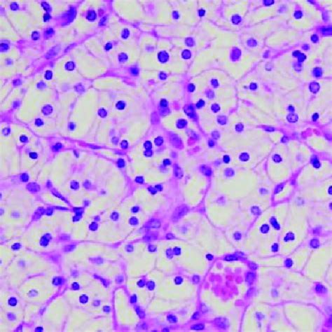 Chromophobe RCC and oncocytoma. (a) Chromophobe RCC, representative ...