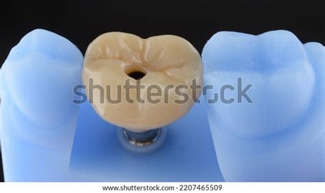 167 Screw Retained Implant Images, Stock Photos, 3D objects, & Vectors | Shutterstock