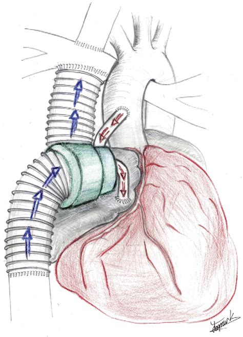 In Vitro Validation Of A Self Driving Aortic Turbine Venous Assist