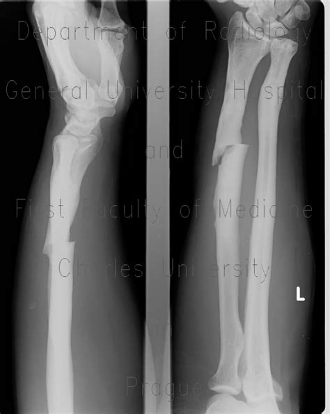 Radiology case: Fracture of the shaft of radius, secondary healing ...