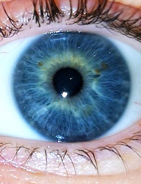 I Have A Bright Yellow Ring Around The Pupil Of My Dark Blue Eyes And