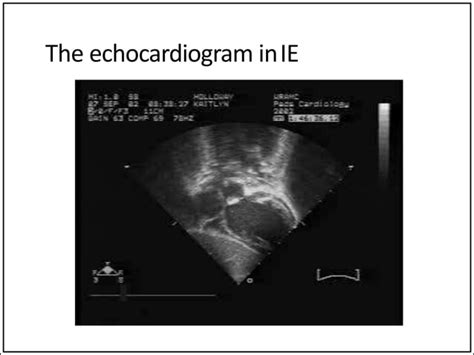 Infective Endocarditis Paediatrics Ppt