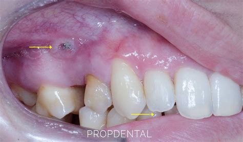 Microimplantes de ortodoncia Qué son Microtornillos de ortodoncia