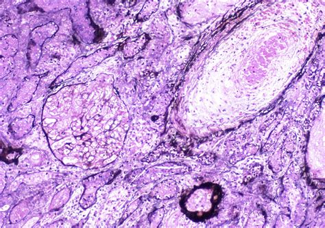 Ajkd Atlas Of Renal Pathology Thrombotic Microangiopathy American