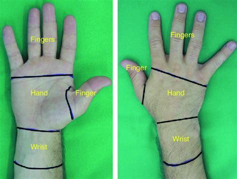 Local anesthetic injection sites of epinephrine in the wrist, hand, and ...