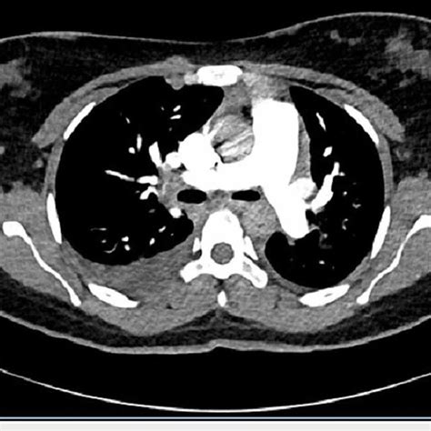 Ct Pulmonary Angiogram Showing No Evidence Of Pulmonary Embolism Download Scientific Diagram