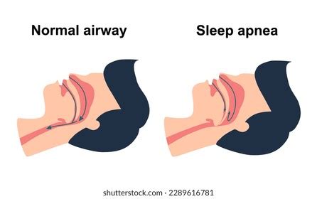 Sleep Apnea Diagram Royalty-Free Images, Stock Photos & Pictures ...